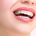 Understanding the Cost of Braces Treatment in Parel Mumbai