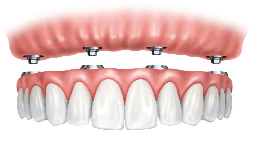 Are Implant Supported Dentures Worth It? Benefits, Costs & Process