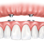 Are Implant Supported Dentures Worth It? Benefits, Costs & Process