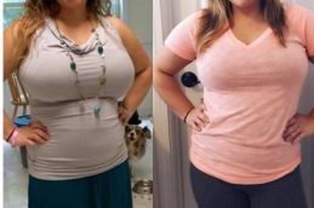 Body Lift in Dubai – Complete Guide to Body Contouring Surgery