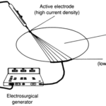 Electrosurgery Market Trends: The Rise of AI and Robotic-Assisted Surgery