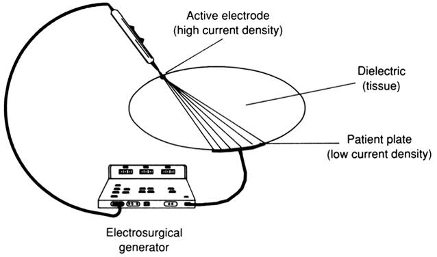 Electrosurgery Market Trends: The Rise of AI and Robotic-Assisted Surgery