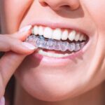 Planning Clear Aligners? A Simple Guide to Cost in Prashant Vihar