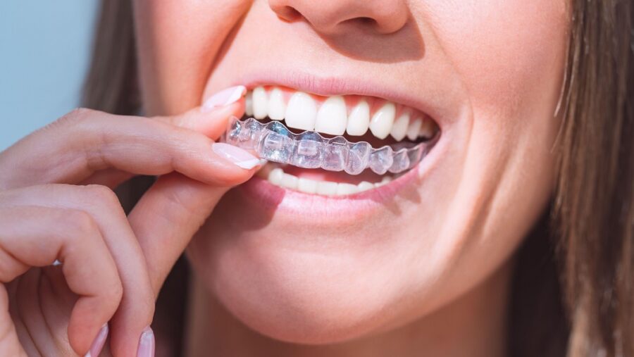 Planning Clear Aligners? A Simple Guide to Cost in Prashant Vihar
