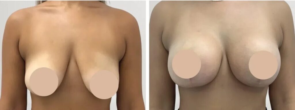 Breast Reduction Surgery in Dubai for Enhanced Comfort and Confidence