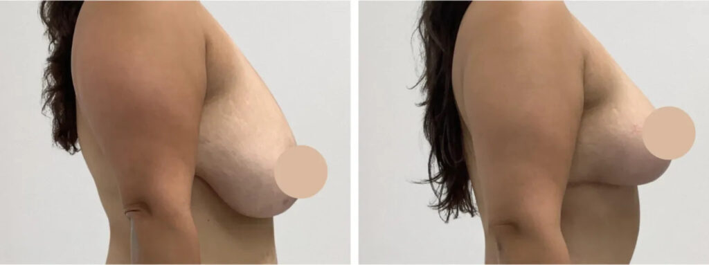 Breast Lift Surgery in Dubai for Beautiful and Balanced Contours