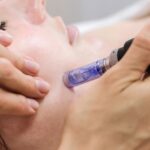 Microneedling in Manchester: Stimulate Collagen for Healthier Skin