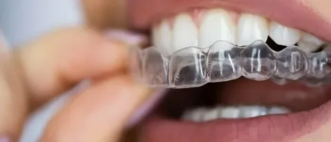 Invisible Braces Timeline: How Long Does It Really Take
