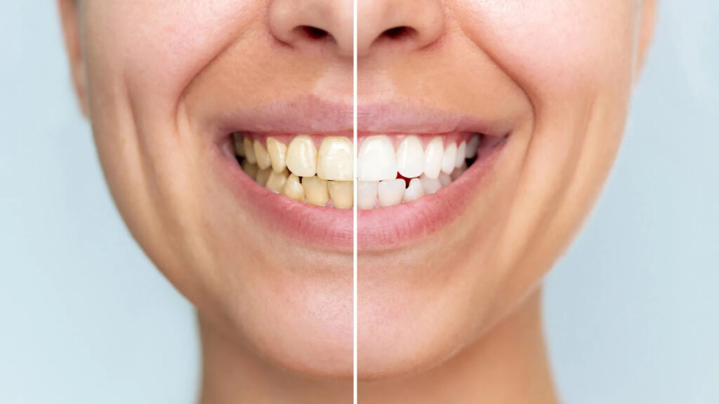 Dull or Stained Teeth? Discover Teeth Whitening in Bilaspur