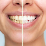 Dull or Stained Teeth? Discover Teeth Whitening in Bilaspur