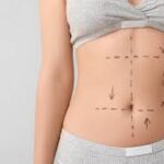 Tummy Tuck Cost: Factors That May Influence the Total Price