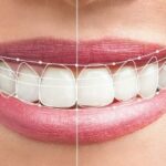 Design Your Dream Smile with Digital Smile Designing