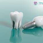How Many Teeth Can Be Fixed on One Implant? A Complete Guide for Indian Patients