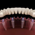 Full Mouth Tooth Loss? Discover All-on-4 Implants in Nashik