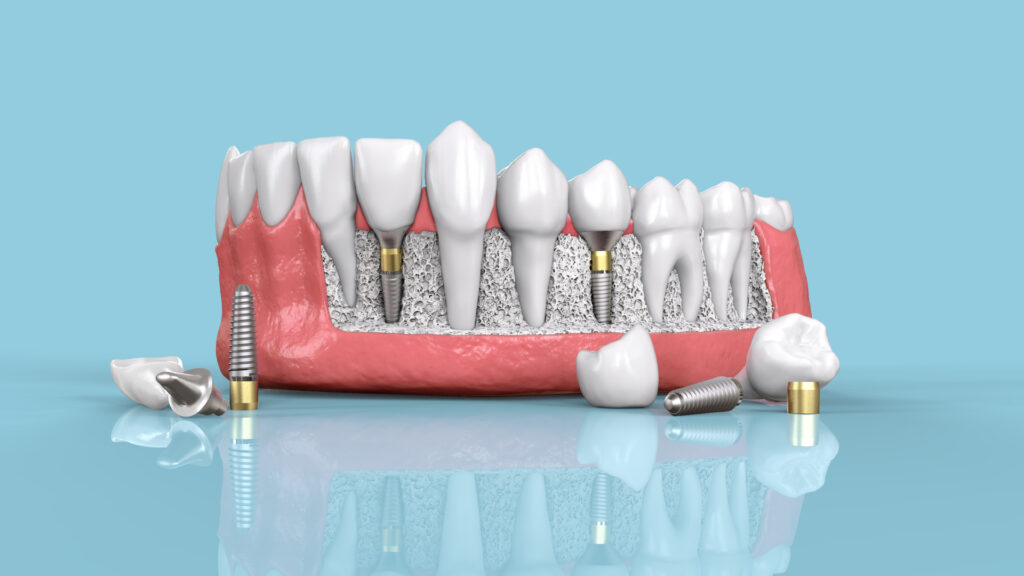 Top Reasons Dental Implants Fail and How to Prevent Them