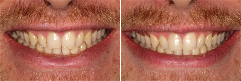 Affordable Veneers: How to Get a Great Smile on a Budget