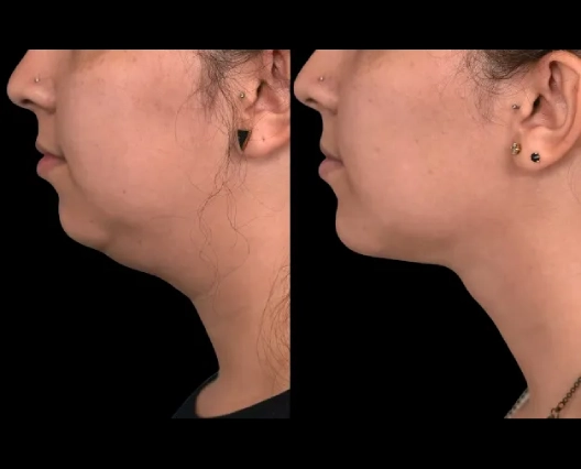 Financing Options for Double chin removal Surgery in dubai