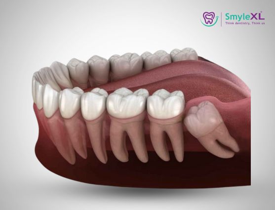 Can Wisdom Tooth Extraction Change Face Shape?