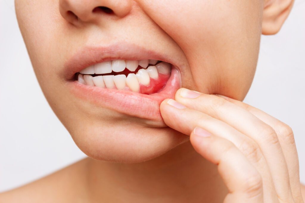 How Long Should a Tooth Abscess Stay Swollen?