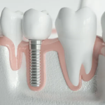 Understanding the Steps and Benefits of Root Canal Treatment in Badlapur