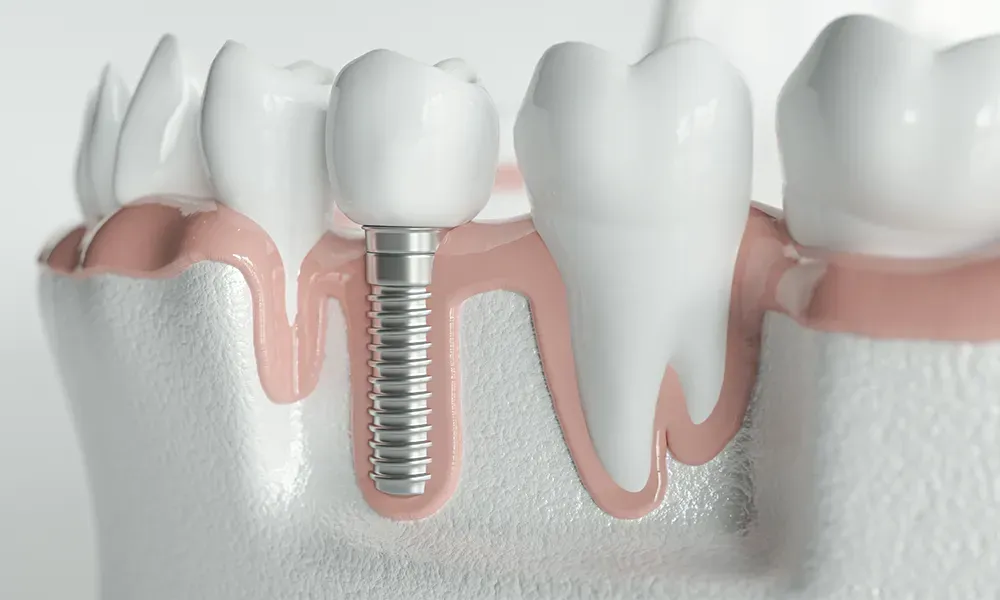Understanding the Steps and Benefits of Root Canal Treatment in Badlapur