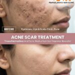 The Ultimate Guide to Acne Scar Treatment Cost in Pune: Reclaim Your Flawless Skin