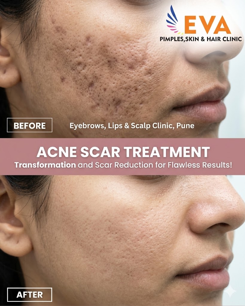 The Ultimate Guide to Acne Scar Treatment Cost in Pune: Reclaim Your Flawless Skin