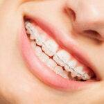 Smart Smile Solutions: Why Downtown Portland Braces Are Evolving with Modern Damon Technology