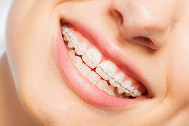 Smart Smile Solutions: Why Downtown Portland Braces Are Evolving with Modern Damon Technology