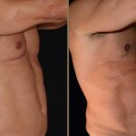 Vaser 4D Liposuction Cost Breakdown You Should Know