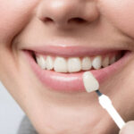 Are Dental Veneers the Right Choice for Your Smile Goals?