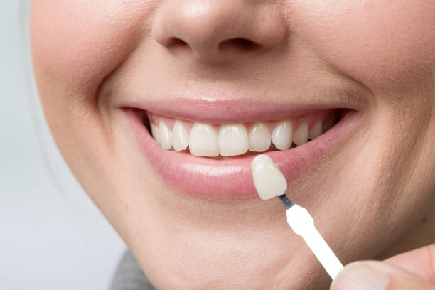 Are Dental Veneers the Right Choice for Your Smile Goals?