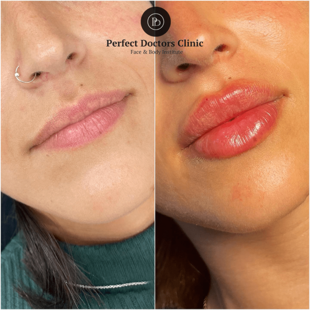 Travel-Friendly Beauty Treatments Like Juvederm in Dubai