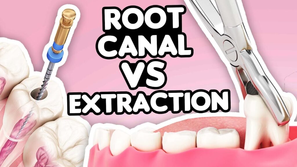 Should I Get a Root Canal or Just Extract the Tooth?