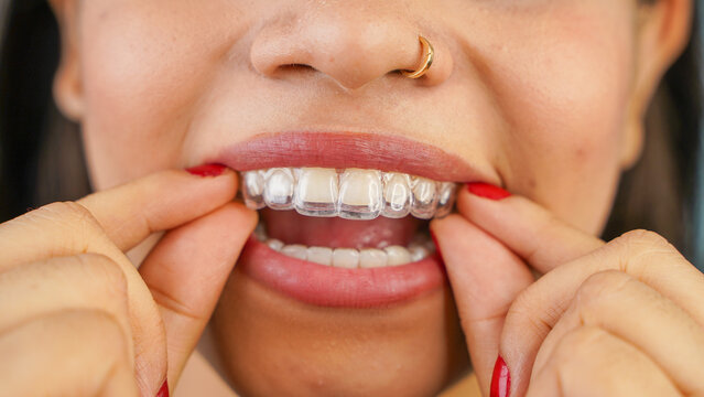 How Much Do Invisible Braces / Aligners / Invisalign Cost?