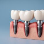 Dental Implants in Nashik: What to Expect Before and After Treatment