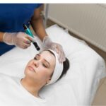 How Does Morpheus8 Microneedling Fractional Treatment Improve Acne Scars?