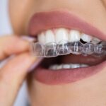 The Modern Way to a Straighter Smile: Clear Aligners Treatment in Wanowrie