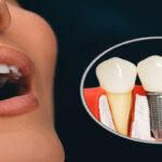 Benefits of Dental Implants You Should Know About
