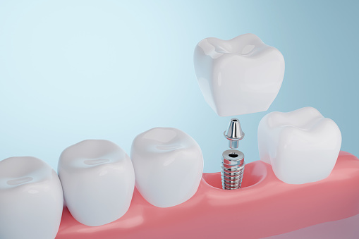 Understanding Dental Implants: What Exactly is the Abutment?