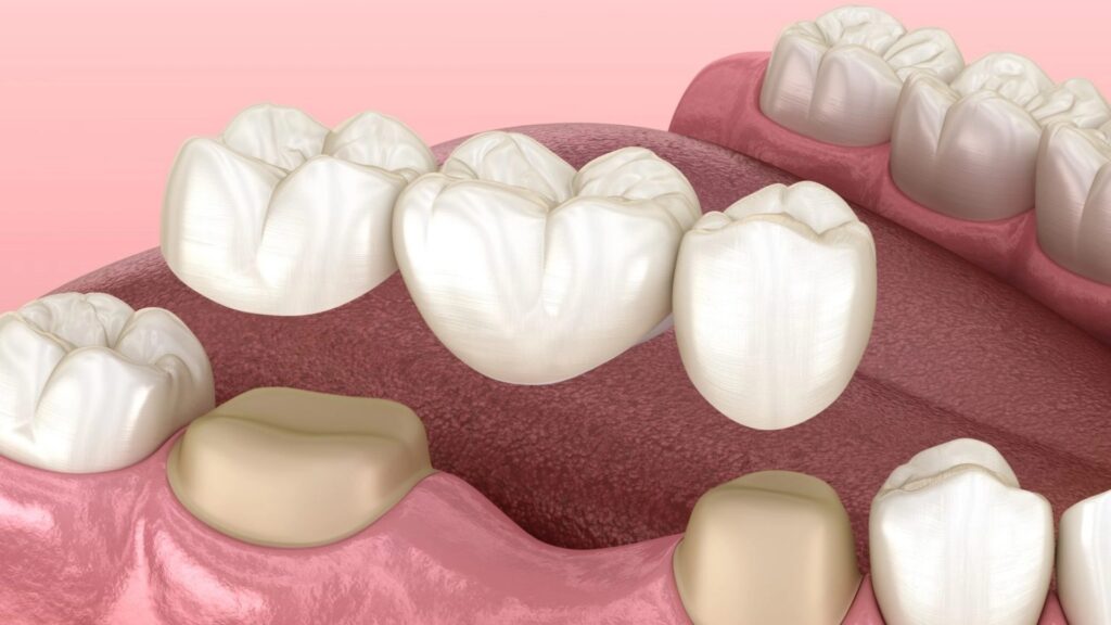 AI in Restorative Dentistry: Smarter Crown and Bridge Planning Explained