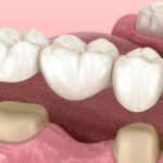 AI in Restorative Dentistry: Smarter Crown and Bridge Planning Explained