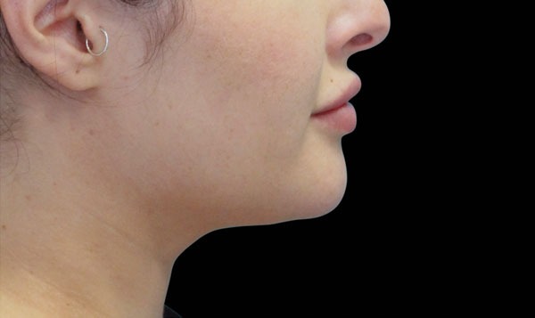 Cryolipolysis Dubai – Non-Surgical Fat Reduction for a Confident New You