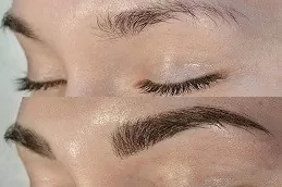 Best Eyebrow Hair Transplant in Dubai: Expert Tips for Natural Results