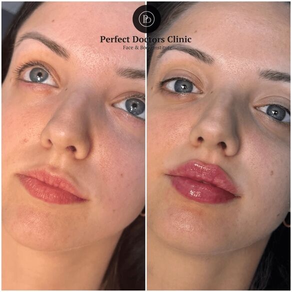 Juvederm Treatments in Dubai for Natural Anti-Aging Results
