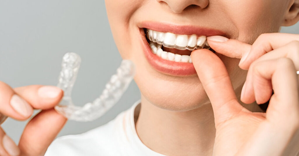 Smile Confidently with Invisible Braces