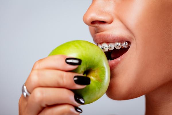 What You Should and Shouldn’t Eat When You Have Braces