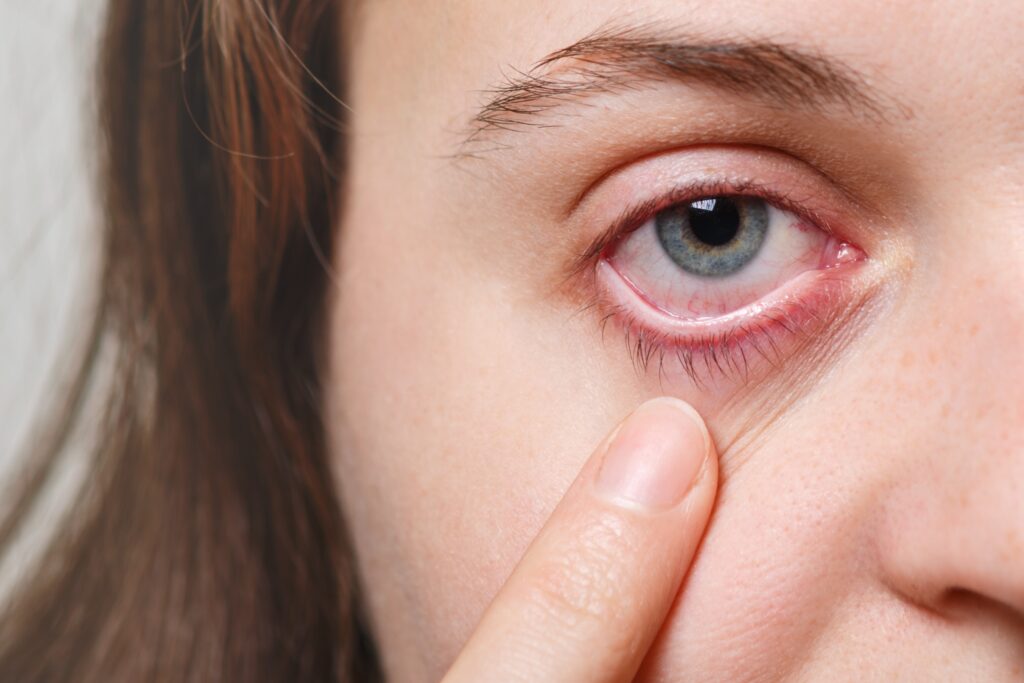 Urgent Care in Chicago for Pink Eye Symptoms and Treatment