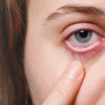 Urgent Care in Chicago for Pink Eye Symptoms and Treatment