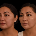 How Experts Achieve Natural Results With Double chin removal Surgery in dubai